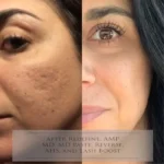 كولانوج غسول رغوي للتقشير الدقيق - Kolanog micro-peeling foam cleanser